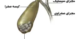 کپسول دفع سنگ کیسه صفرا + خواص و کاربرد و بهترین زمان مصرف و عوارض آن