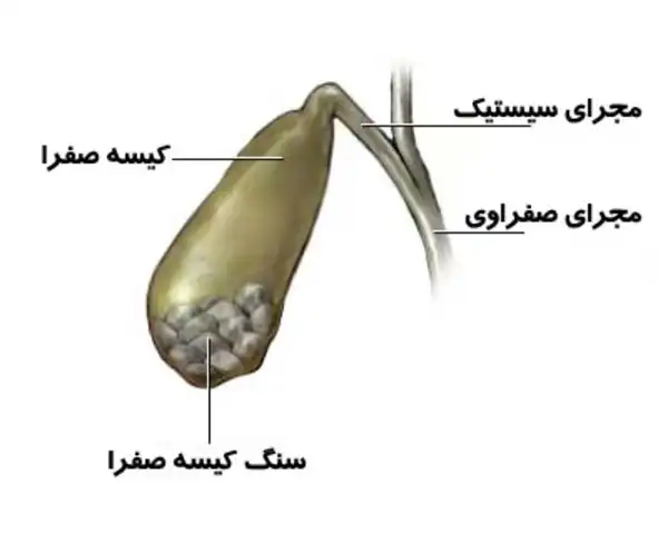 کپسول دفع سنگ کیسه صفرا + خواص و کاربرد و بهترین زمان مصرف و عوارض آن