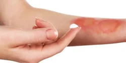 پماد سوختگی + خواص و کاربرد و بهترین زمان مصرف و عوارض آن