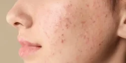 تعبیر خواب جوش + معنی جوش زدن در خواب چیست