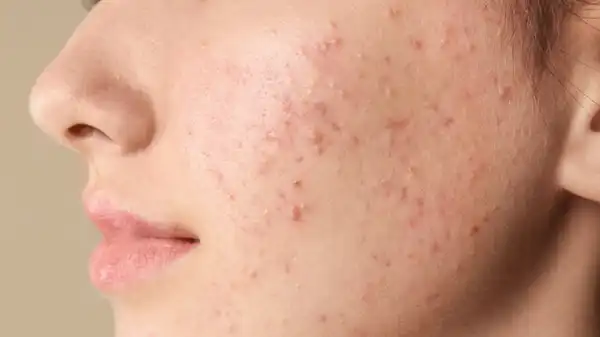 تعبیر خواب جوش + معنی جوش زدن در خواب چیست