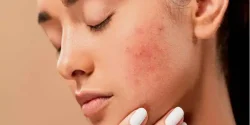 تعبیر خواب جوش صورت + از دید امام صادق و ابن سیرین و حضرت یوسف