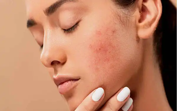 تعبیر خواب جوش صورت + از دید امام صادق و ابن سیرین و حضرت یوسف