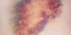 تعبیر خواب کبودی صورت دیگران + از دید امام صادق و ابن سیرین و حضرت یوسف