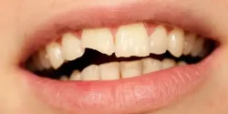 تعبیر خواب شکستن دندان + از دید امام صادق و ابن سیرین و حضرت یوسف
